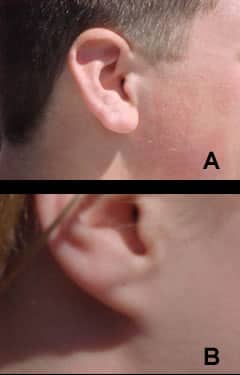 Detached and Attached Earlobes