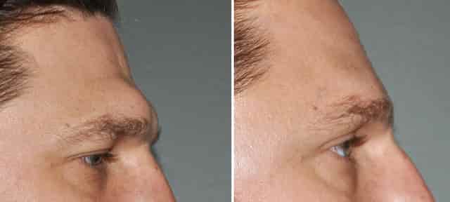 Prominent and flat brow bones in face reading