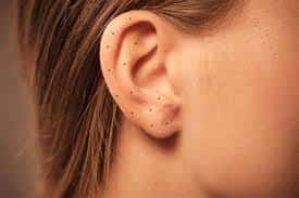 Moles on the ears meaning